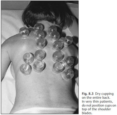 The Art of Cupping
