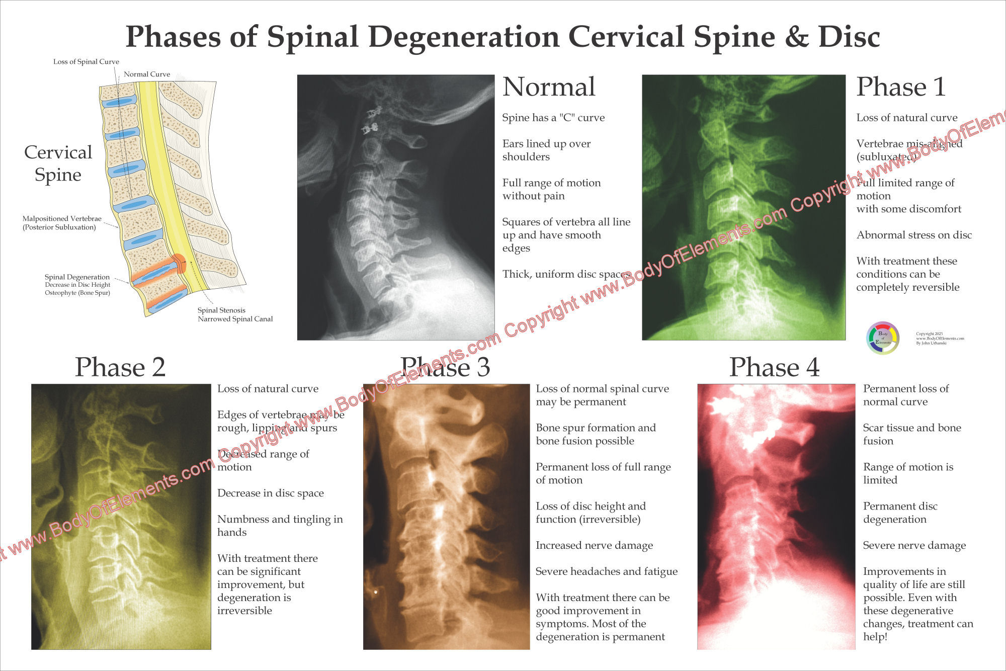 Spinal Degeneration Poster