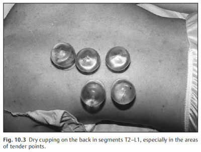 The Art of Cupping