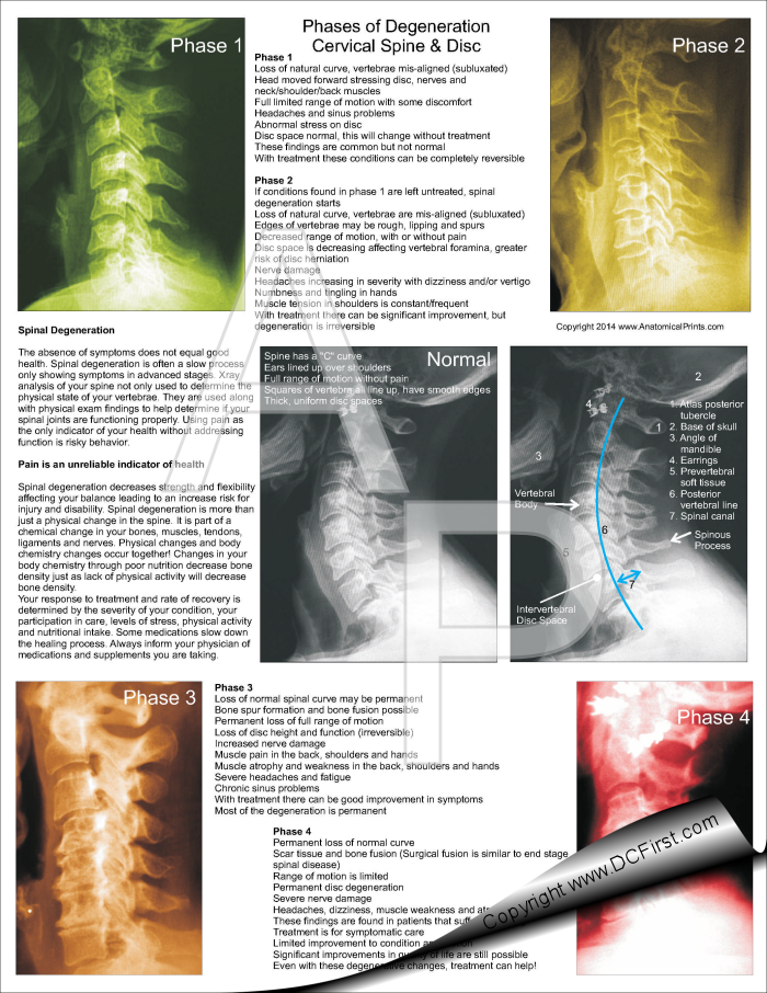 Cervical Spinal Degeneration Pad