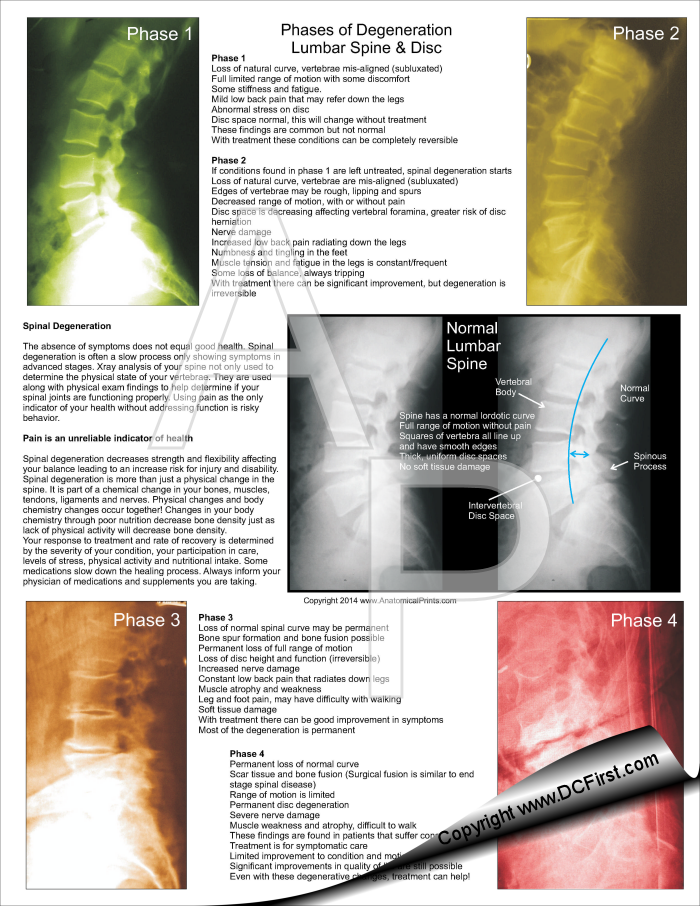 Lumbar Spinal Degeneration Tear Off Pad