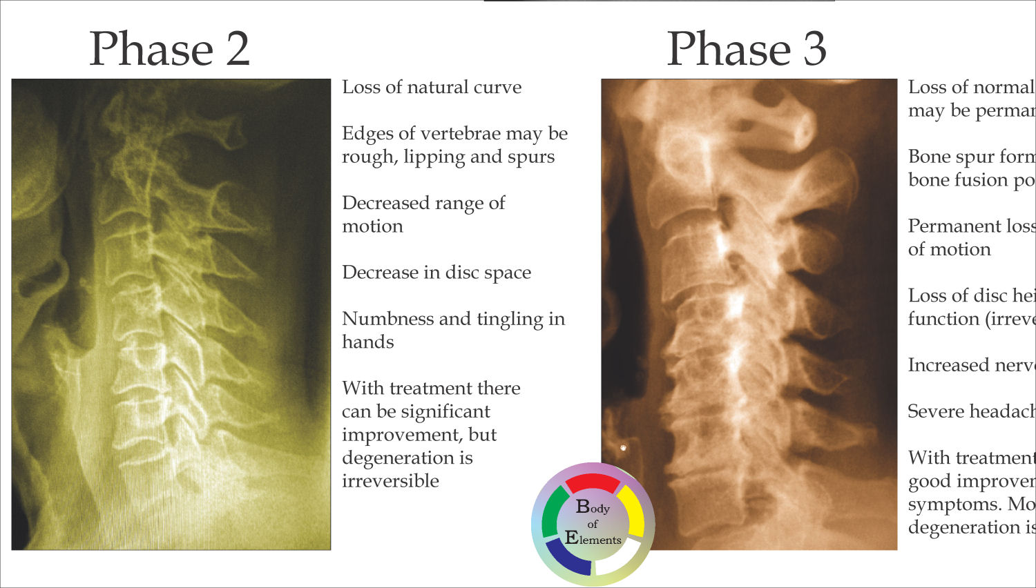 Spinal Degeneration Poster