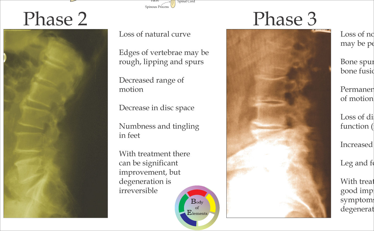 Spinal Degeneration Poster