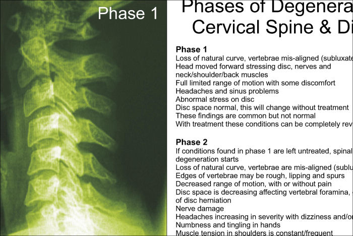 Spinal Degeneration Poster