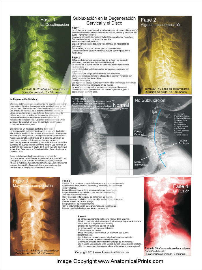 Subluxation Degeneration Poster