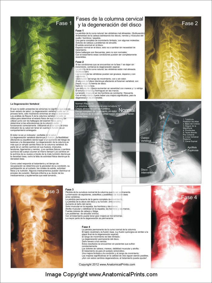 Spinal Degeneration Poster