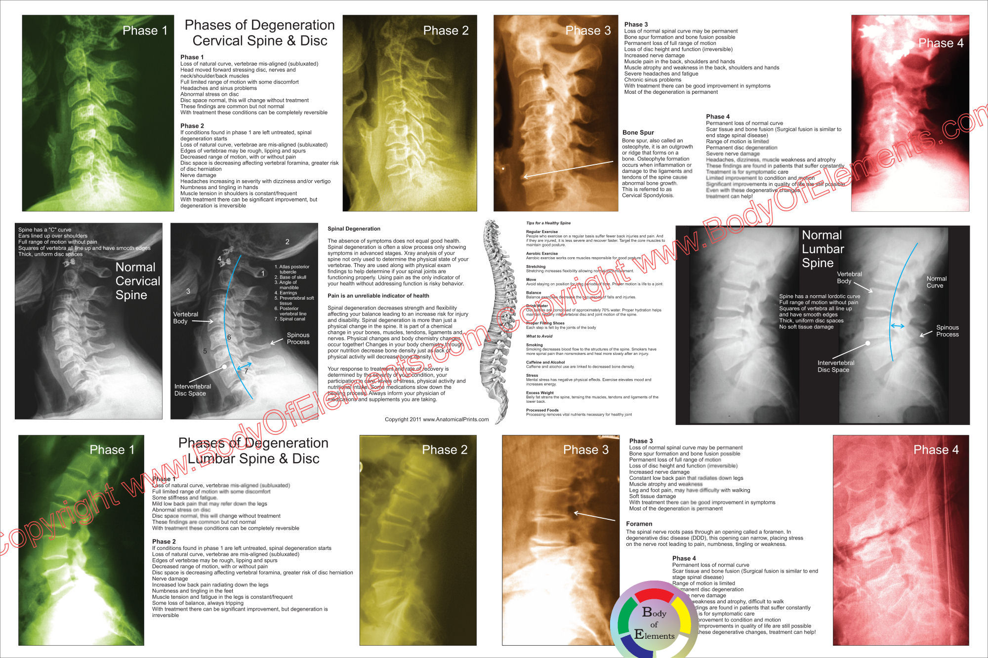 Spinal Degeneration Poster