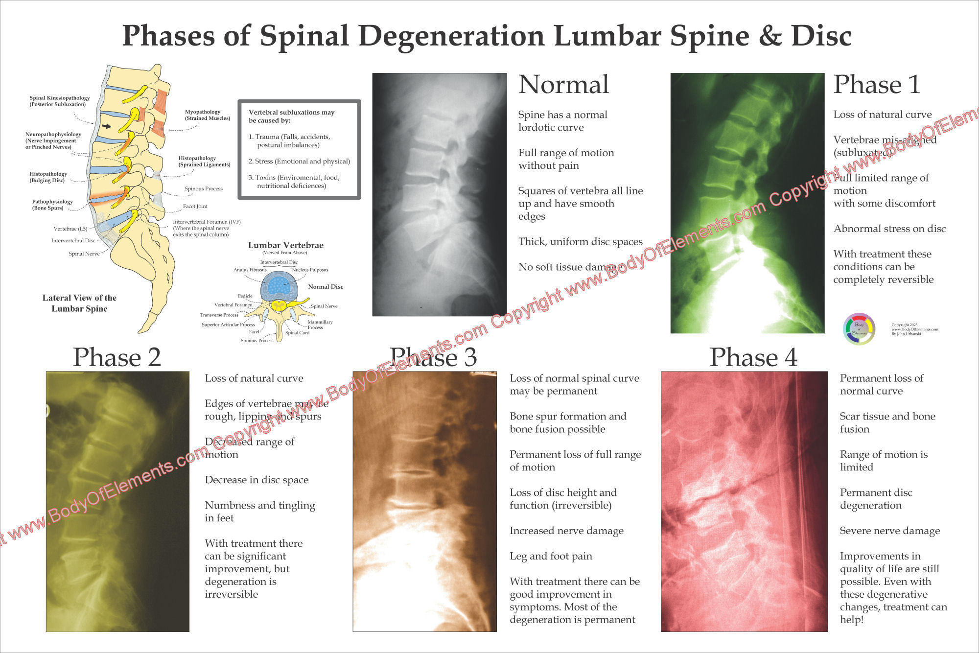 Spinal Degeneration Poster