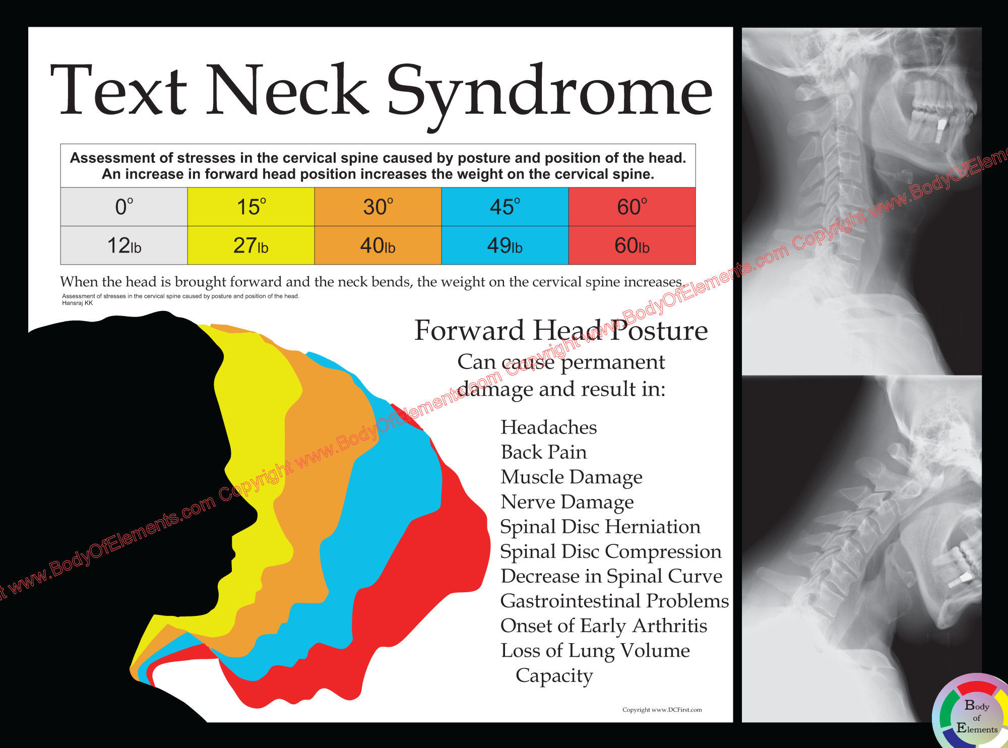 Text Neck Syndrome Poster