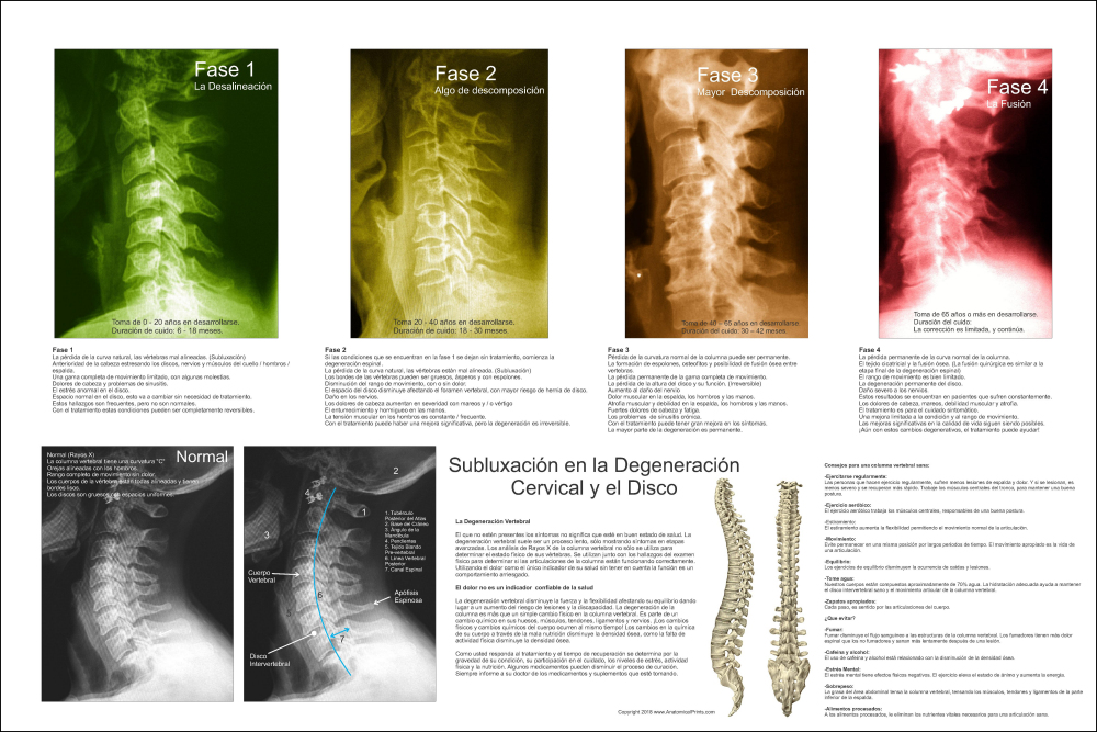 Subluxation Degeneration Poster